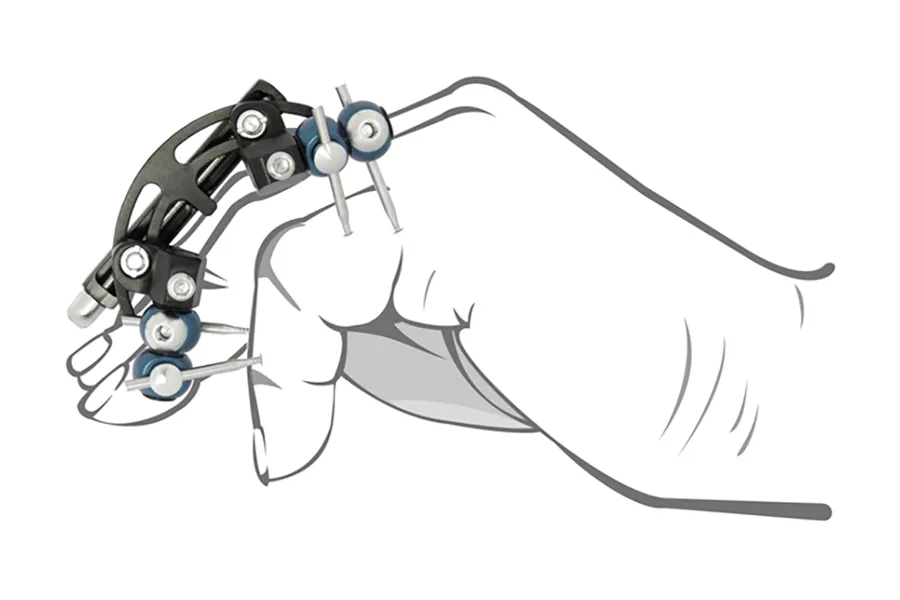 Fijador externo con aplicación dorsal – Dupuytren · imagen 3