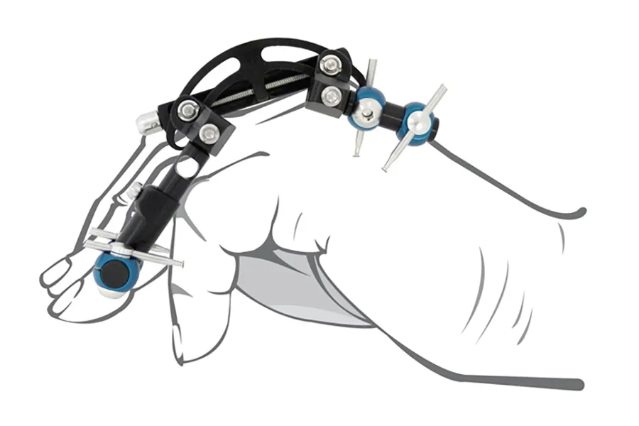 Fijador externo con aplicación dorsal – Dupuytren · imagen 4